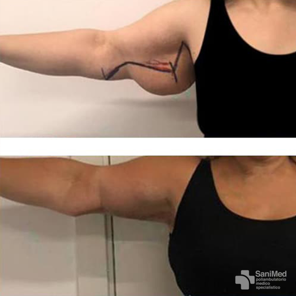 sanimed-roma_Lifting braccia