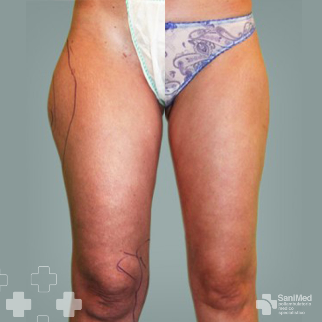 sanimed-roma_Liposuzione