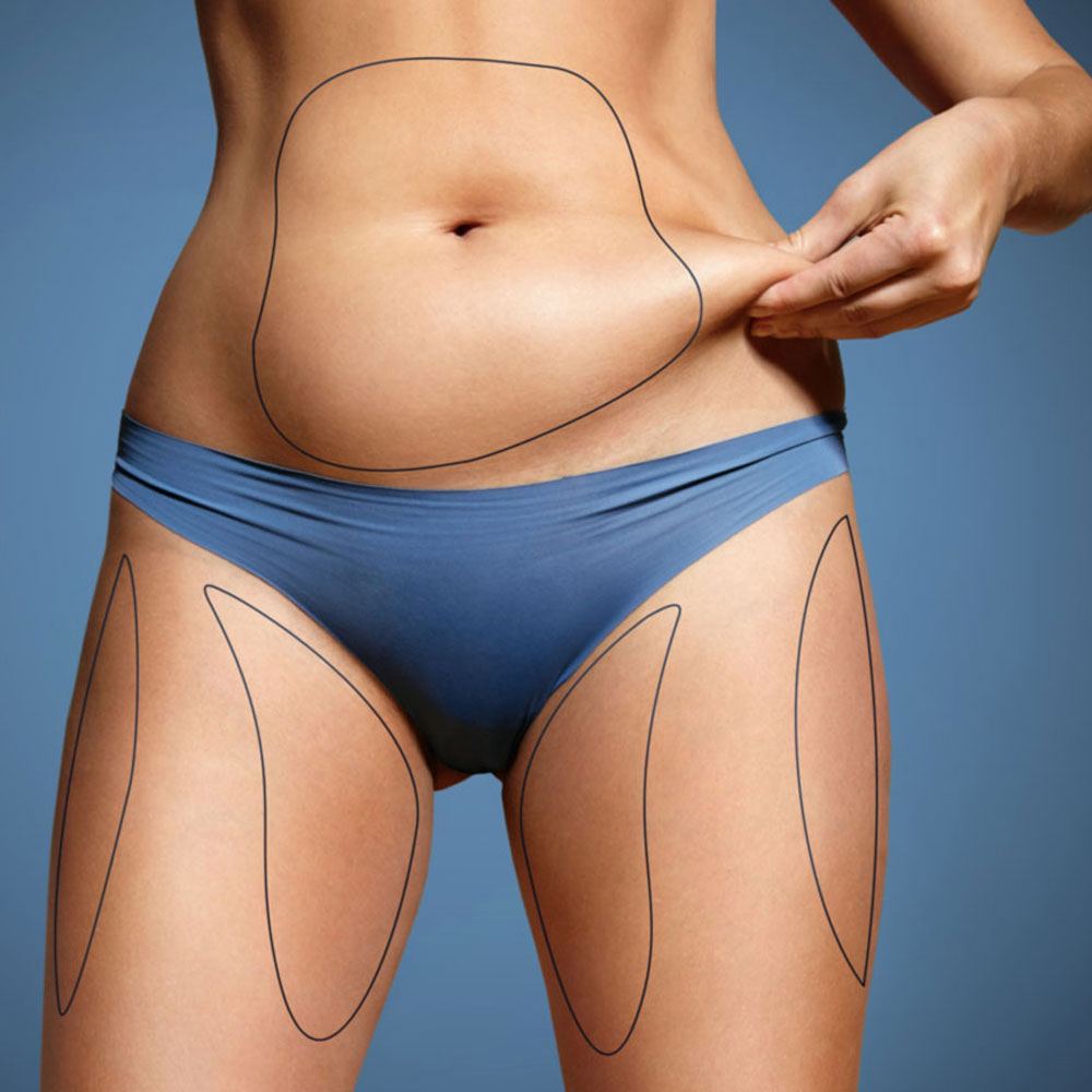 sanimed_liposcultura-non-chirurgica-02